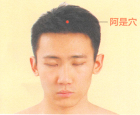 头痛艾灸