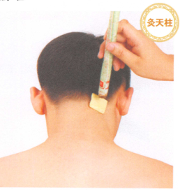 头痛艾灸