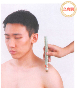 肩周炎艾灸
