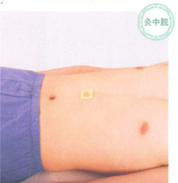 慢性胃炎艾灸