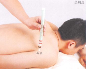 肩周炎艾灸
