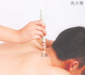 咳嗽艾灸