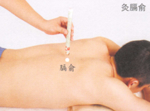 呃逆艾灸