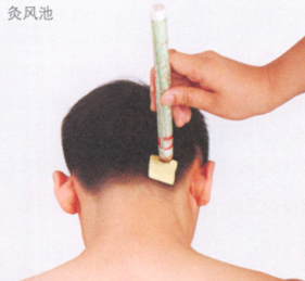 眩晕艾灸