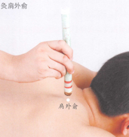 落枕艾灸