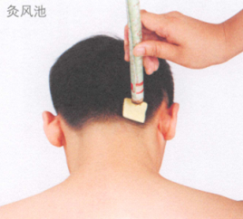 斑秃艾灸