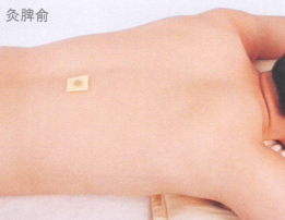 斑秃艾灸