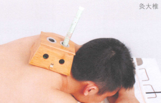 预防感冒艾灸