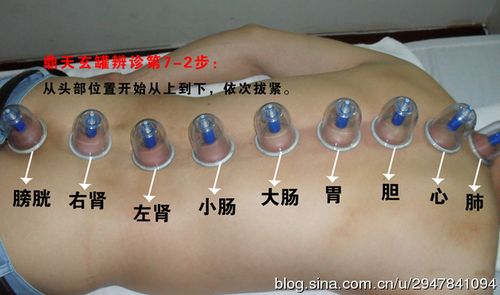 拔罐吸拔部位的选择