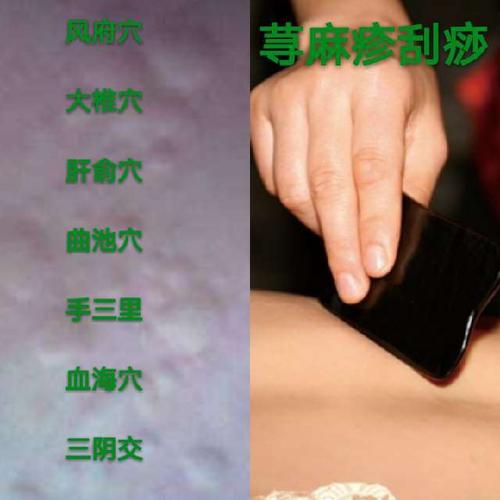 荨麻疹的刮痧疗法