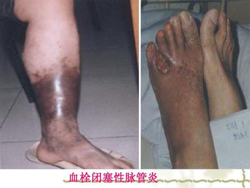 血栓闭塞性脉管炎的刮痧疗法