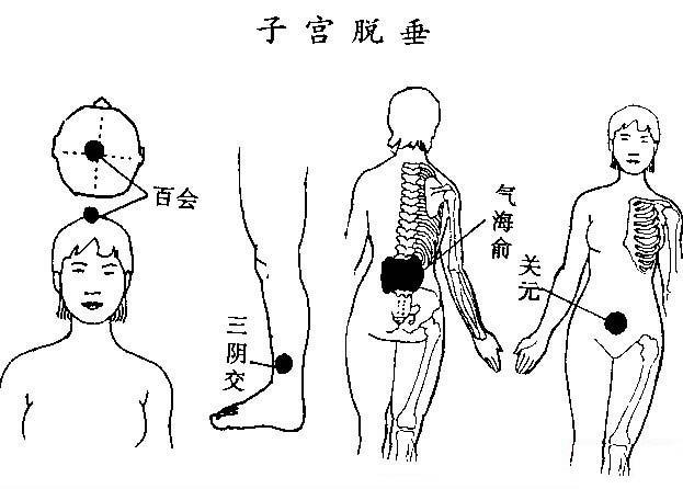 子宫脱垂的刮痧疗法