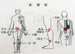 尿潴留(癃闭)的刮痧疗法