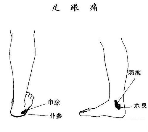 足跟痛的刮痧疗法