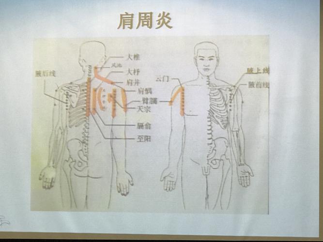 肩周炎的刮痧疗法