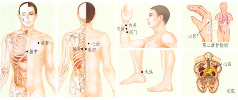 冠心病刮痧