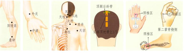 颈椎病刮痧