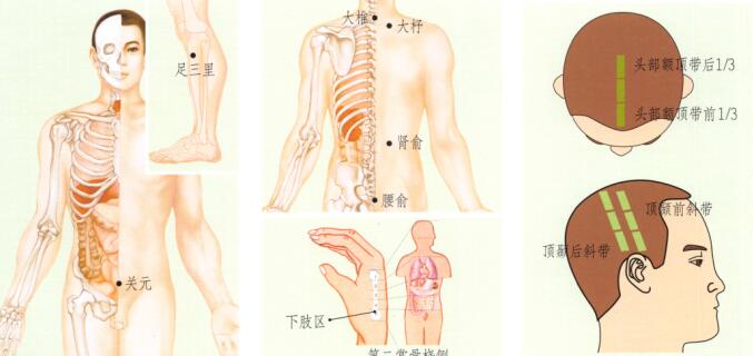 风湿性关节炎刮痧