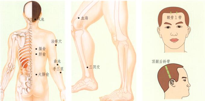 荨麻疹刮痧