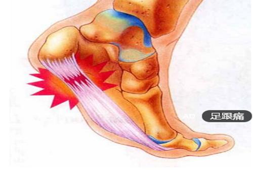 足跟痛是怎么回事该怎么办仙人掌敷