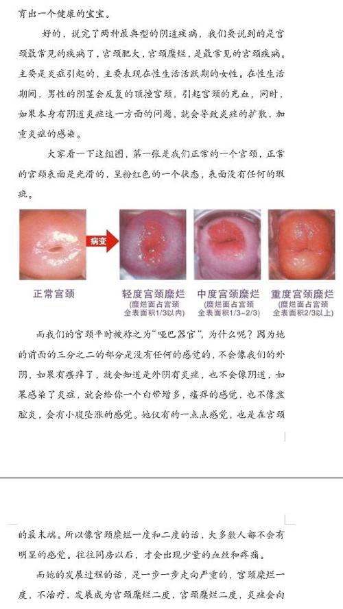 宫颈糜烂怎么治疗最快宫颈糜烂最好偏方大全