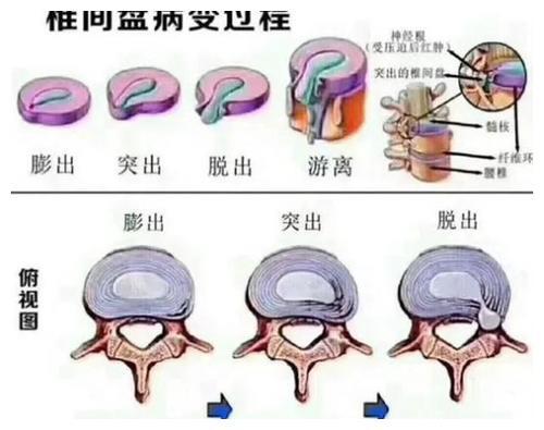 腰椎间盆突出怎么办精油沐浴治疗