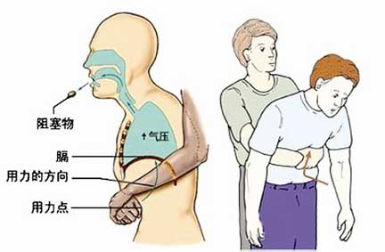 突发危及时，针对病人的一些常用按穴急救法