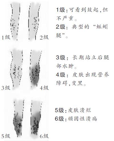 静脉曲张——腿肿“虚”的理疗方法