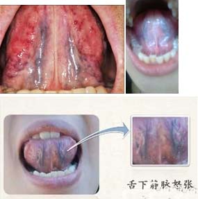 舌下静脉和肛门静脉跟痔疮有关系吗？