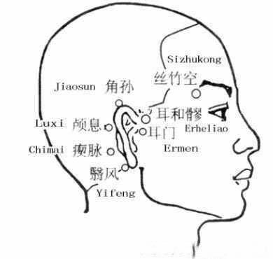 耳聋——中医针灸取穴