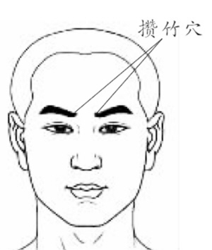 治打嗝止不止的穴位——攒竹穴