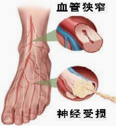 足部血管狭小