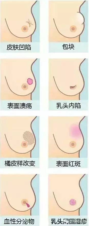 乳腺癌征象图