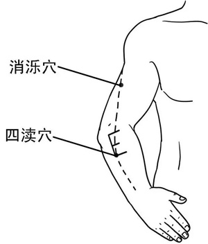 四渎穴、消泺穴、翳风穴