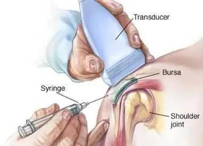 肩关节内进行注射治疗