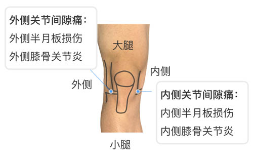 膝盖疼痛的位置和对应调理！