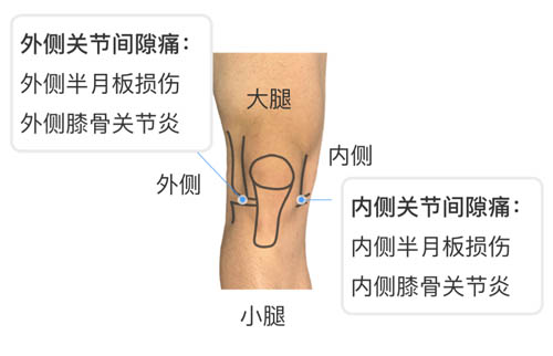 膝盖疼痛的位置和对应调理！