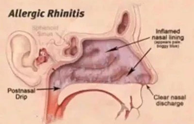 过敏性鼻炎鼻腔