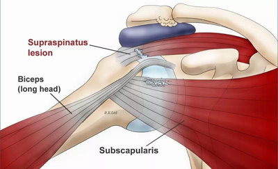 肩袖损伤