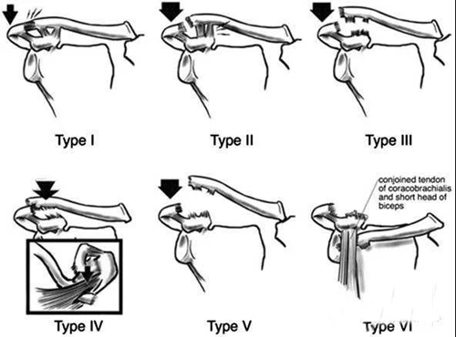 肩锁关节脱位