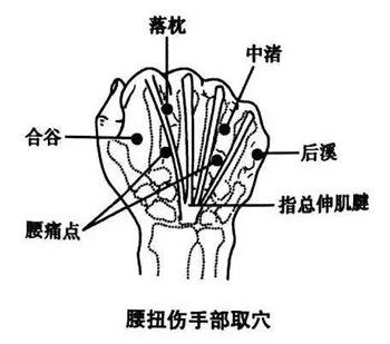 腰扭伤手部取穴