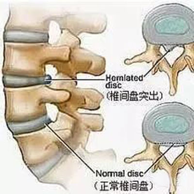 腰间盘突出