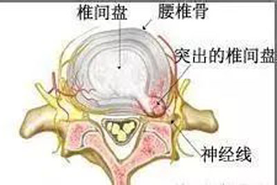 腰间盘突出