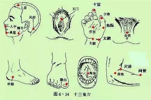 针灸“十三鬼穴”