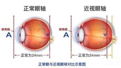 近视眼的中医辩证治疗