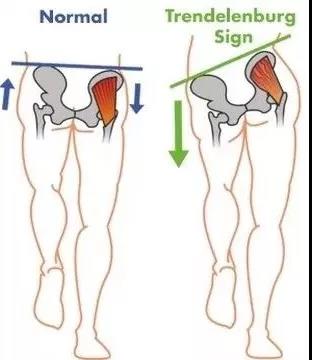 Trdenlenburg步态