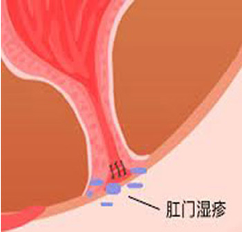 治肛门瘙痒医案