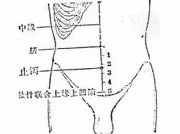 针灸治病的22个奇穴