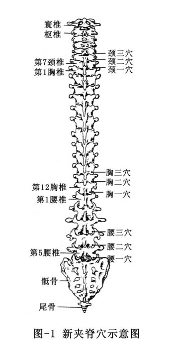 运用“华佗穴”治疗坐骨神经痛验案