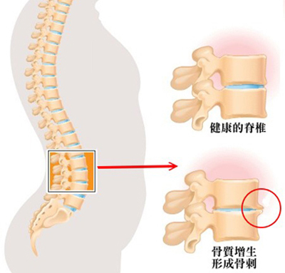 青娥丸治疗骨质增生